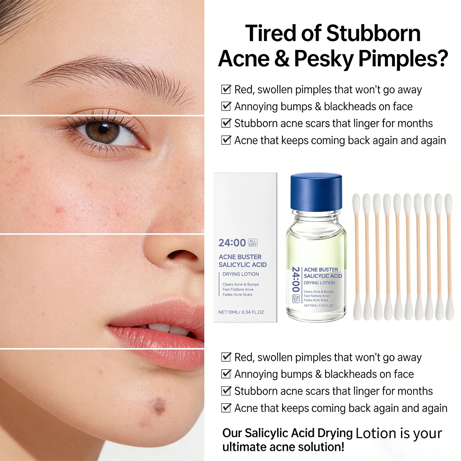 Salicylic Acid Drying Lotion Acne Improve With Cotton Swab Reduce Pimples Fade Acne Scars Minimize Pores Skin Renewal Hydrating