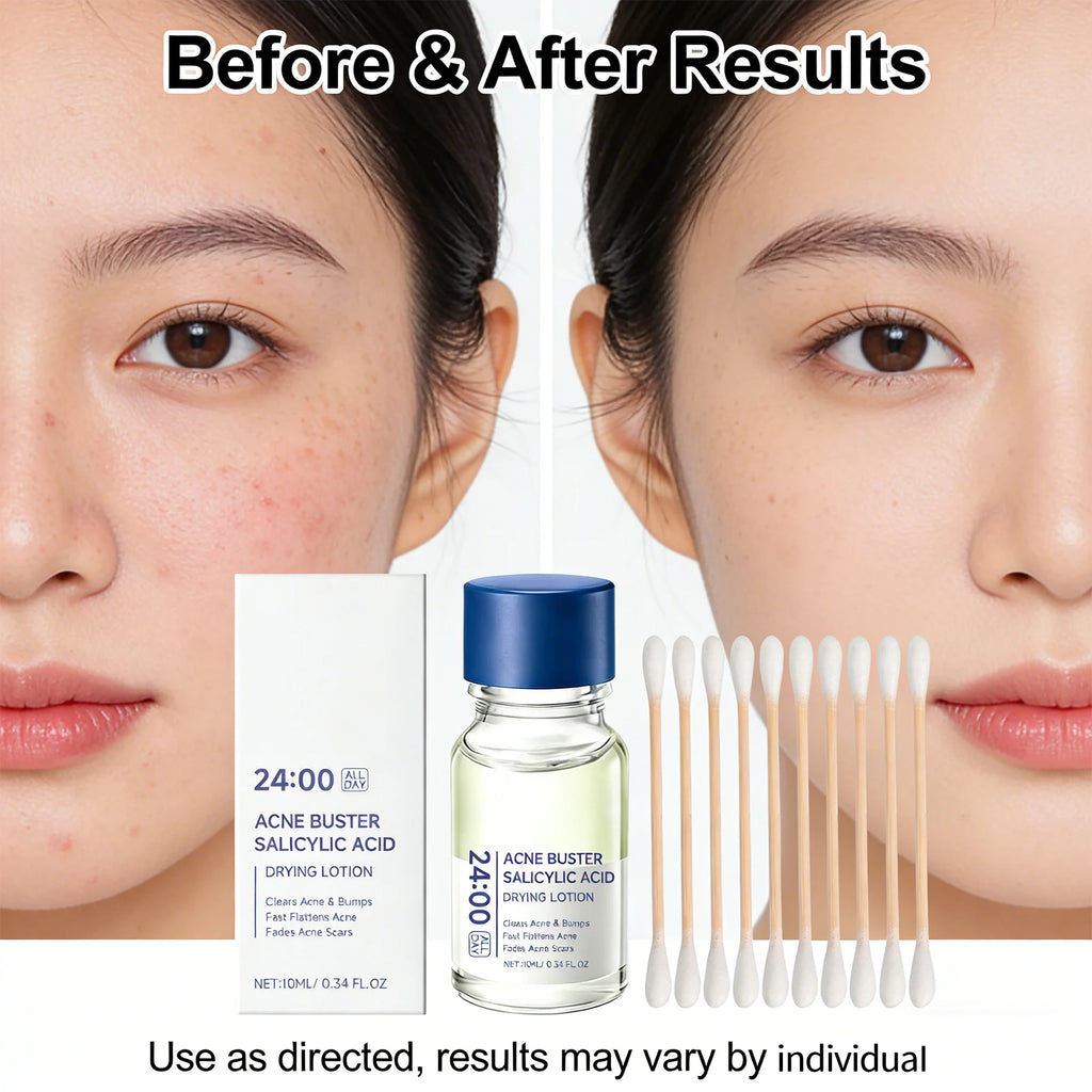Salicylic Acid Drying Lotion Acne Improve With Cotton Swab Reduce Pimples Fade Acne Scars Minimize Pores Skin Renewal Hydrating